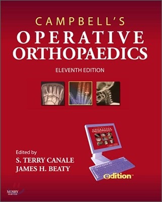 Campbell's Operative Orthopaedics E-Dition, 11/E