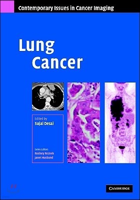 Lung Cancer