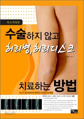 수술하지 않고 허리병, 허리디스크 치료하는 방법