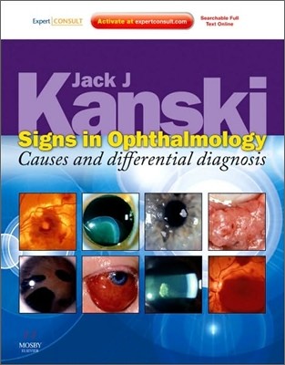 Signs in Ophthalmology