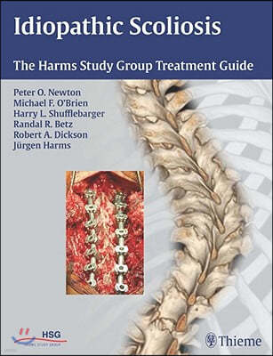 Idiopathic Scoliosis