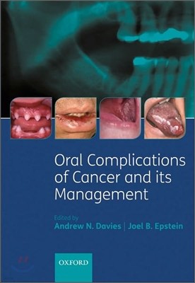 Oral Complications of Cancer and its Management