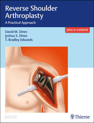 Reverse Shoulder Arthroplasty