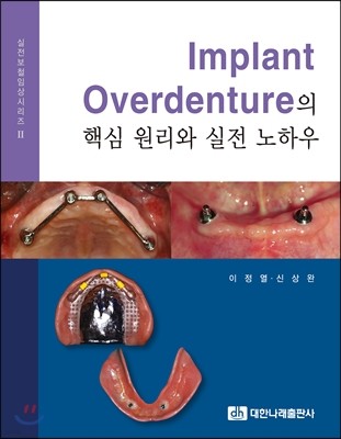Implant Overdenture ٽ   Ͽ 