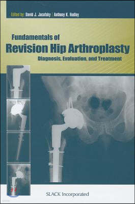 Fundamentals of Revision Hip Arthroplasty: Diagnosis, Evaluation, and Treatment