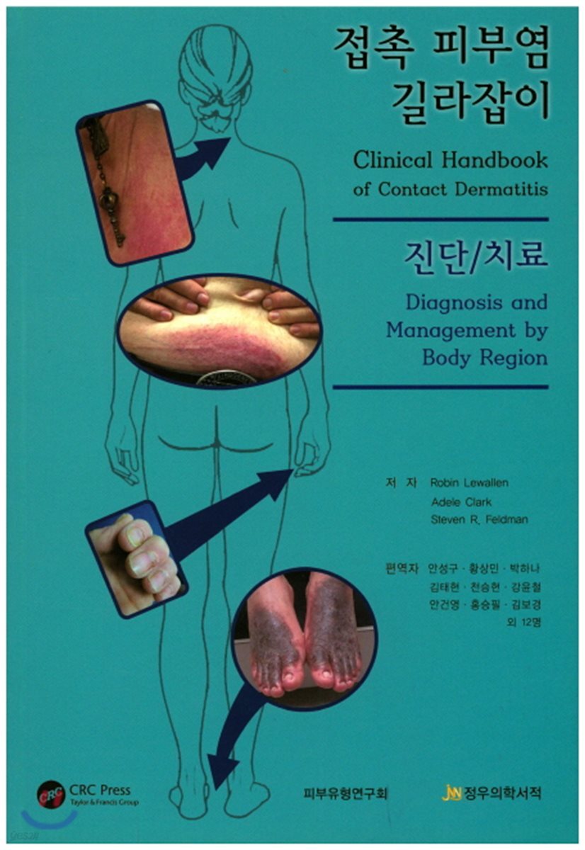 접촉 피부염 길라잡이