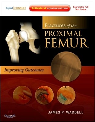 Fractures of the Proximal Femur : Improving Outcomes : Expert Consult