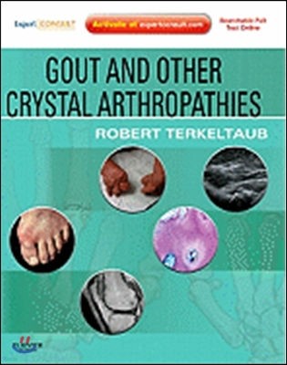 Gout and Other Crystal Arthropathies