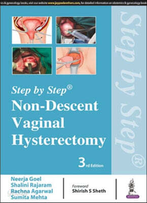 Step by Step: Non-Descent Vaginal Hysterectomy