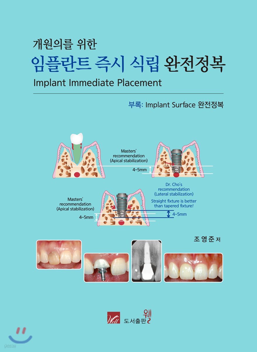 개원의를 위한 임플란트 즉시 식립 완전정복