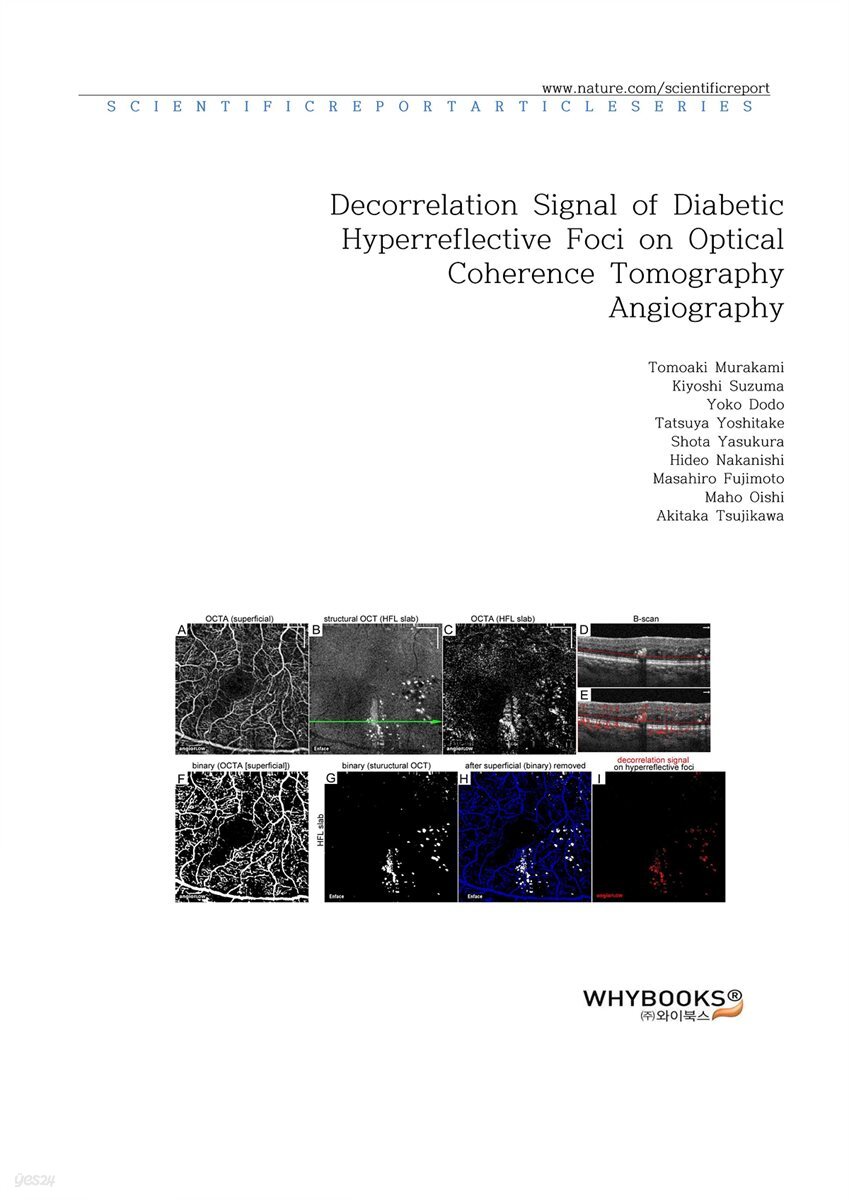 Decorrelation Signal of Diabetic Hyperreflective Foci on Optical Coherence Tomography Angiography