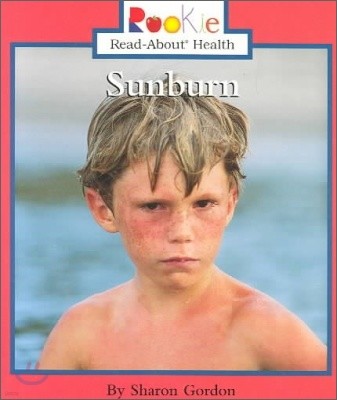 Sunburn