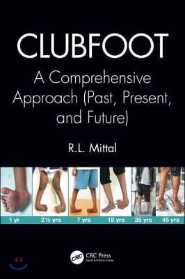 Clubfoot