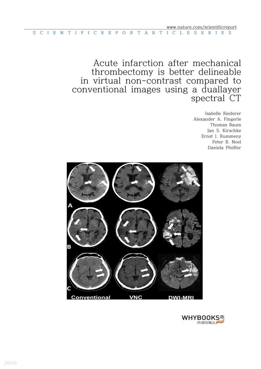 [전자책] Acute infarction after mechanical thrombectomy is better ...