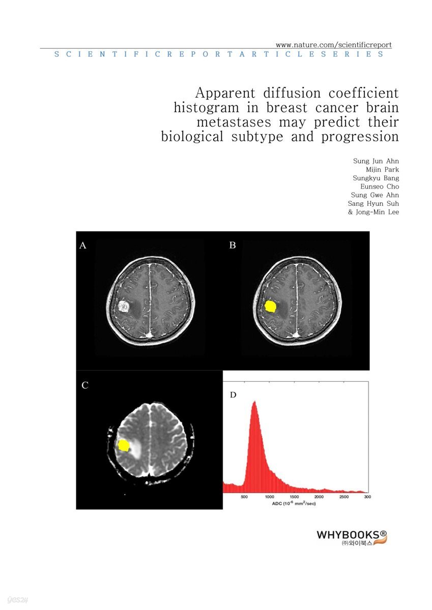 Apparent diffusion coefficient histogram in breast cancer brain metastases may predict their biological subtype and progression