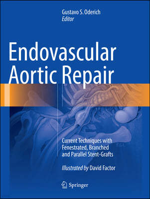 Endovascular Aortic Repair