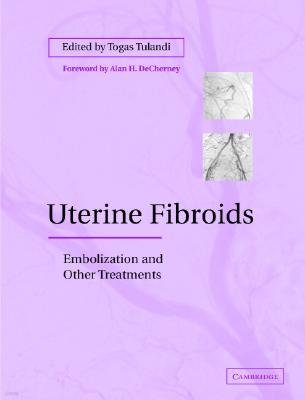 Uterine Fibroids: Embolization and Other Treatments