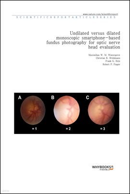Undilated versus dilated monoscopic smartphone-based fundus photography for optic nerve head evaluation