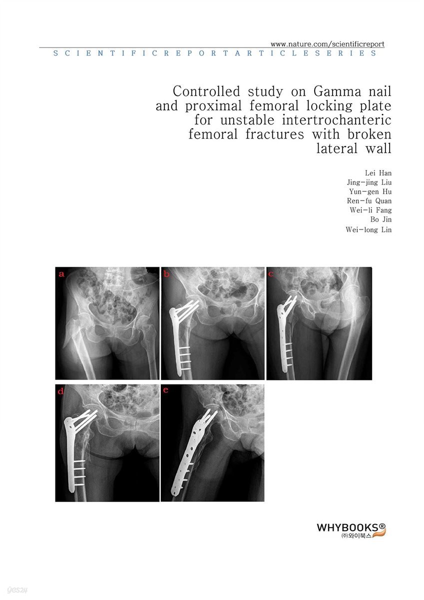 Controlled study on Gamma nail and proximal femoral locking plate for unstable intertrochanteric femoral fractures with broken lateral wall