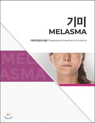 기미 Melasma