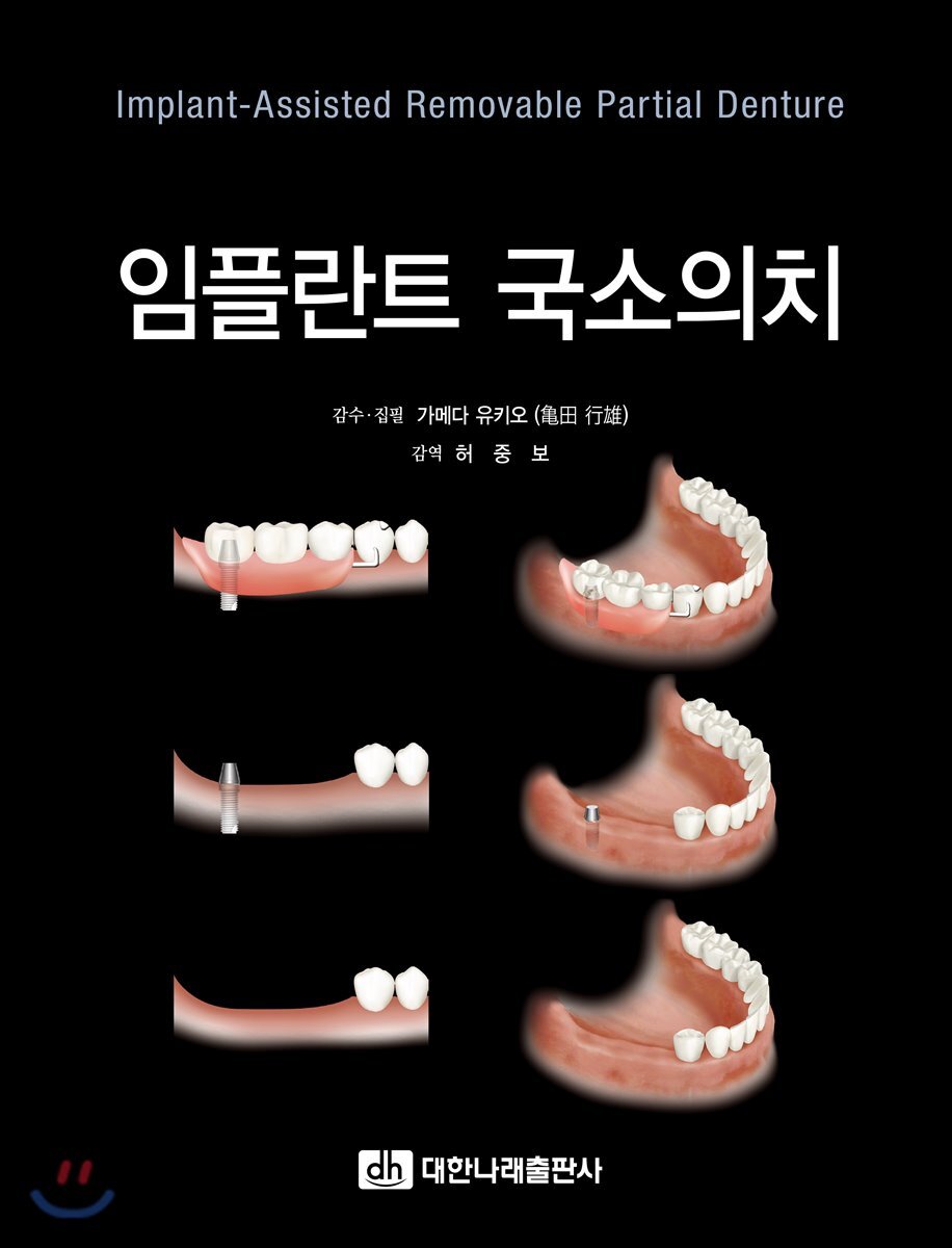 임플란트 국소의치