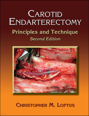 Carotid Endarterectomy: Principles and Technique