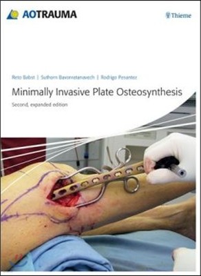 Minimally Invasive Plate Osteosynthesis, 2/E