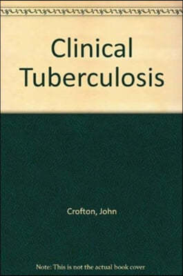 Clinical Tuberculosis Elbs