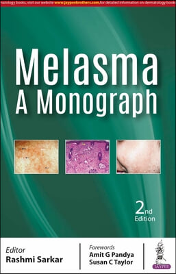 Melasma