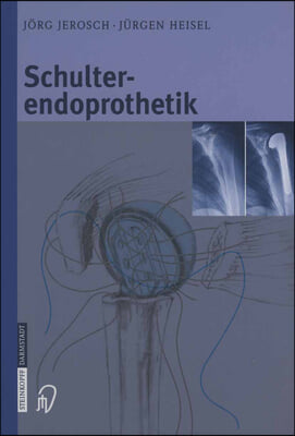 Schulterendoprothetik: Indikation, Implantate, Op-Technik, Nachbehandlung, Begutachtung