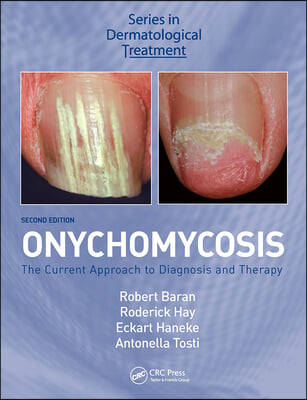 Onychomycosis