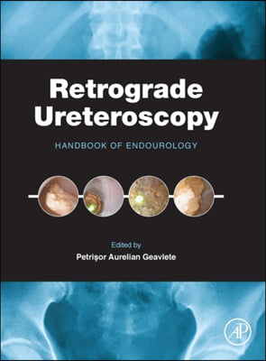 Retrograde Ureteroscopy: Handbook of Endourology