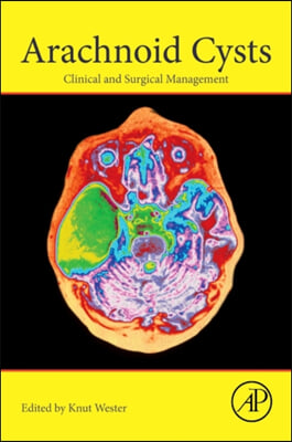 Arachnoid Cysts: Clinical and Surgical Management