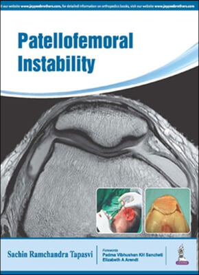 Patellofemoral Instability: Knee Joint