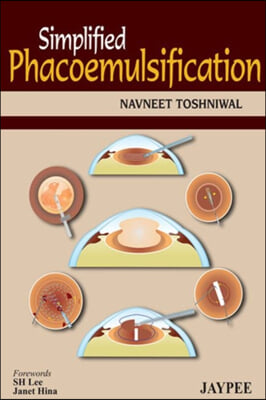 Simplified Phacoemulsification