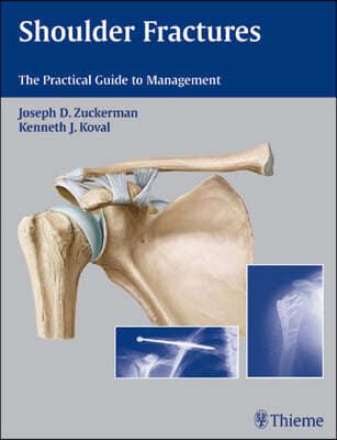 Shoulder Fractures