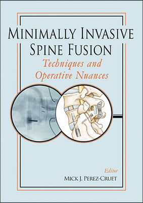 Minimally Invasive Spine Fusion