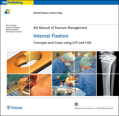 AO Manual of Fracture Management: Internal Fixators