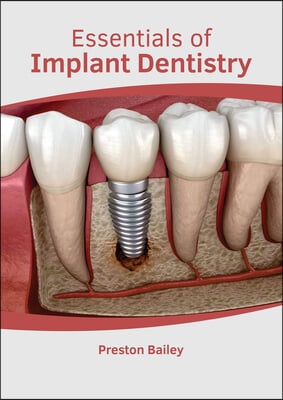 Essentials of Implant Dentistry