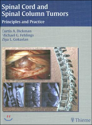 Spinal Cord and Spinal Column Tumors: Principles and Practice