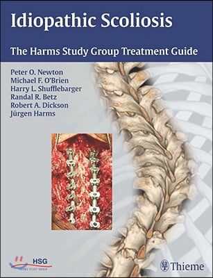 Idiopathic Scoliosis