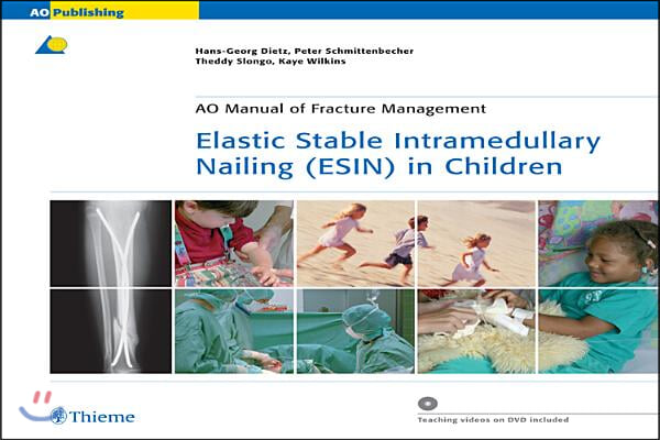 Elastic Stable Intramedullary Nailing Esin in Children
