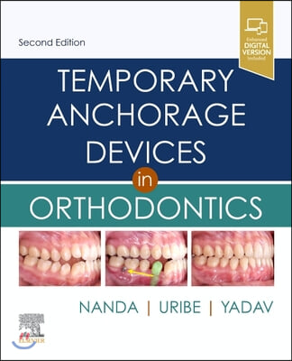 Temporary Anchorage Devices in Orthodontics Elsevier eBook on Vitalsource (Retail Access Card)