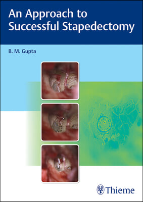 An Approach to Successful Stapedectomy