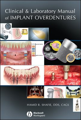 Clinical and Laboratory Manual of Implant Overdentures