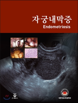 자궁내막증