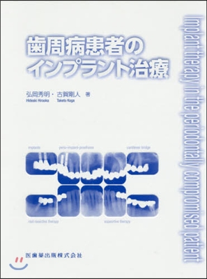 齒周病患者のインプラント治療