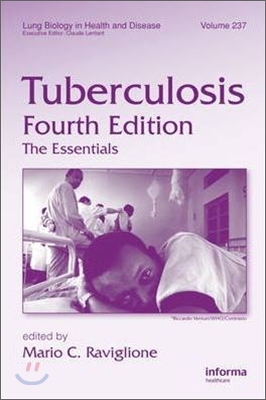 Tuberculosis