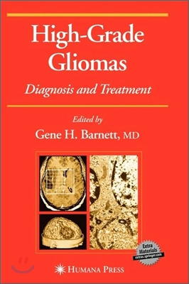 High-Grade Gliomas: Diagnosis and Treatment