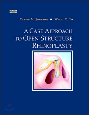 A Case Approach To Open Structure Rhinoplasty